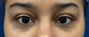 Lower-Blepharoplasty-Case--28049 | After Eyelid Surgery 1