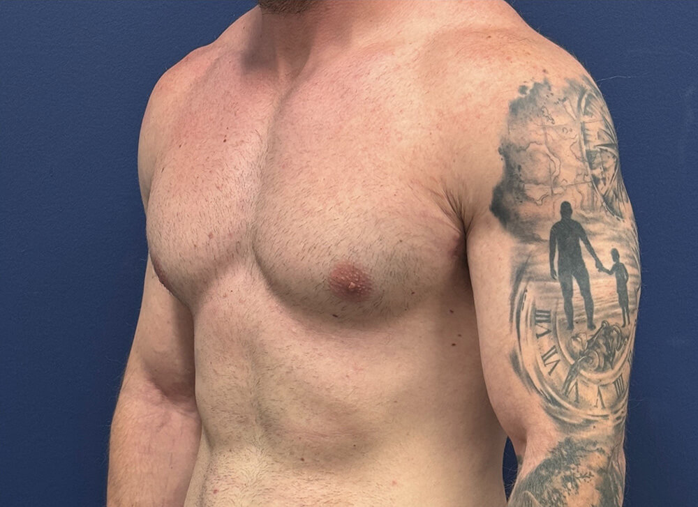 Gynecomastia-Case--28230 | After Gynecomastia / Male Breast Reduction 2