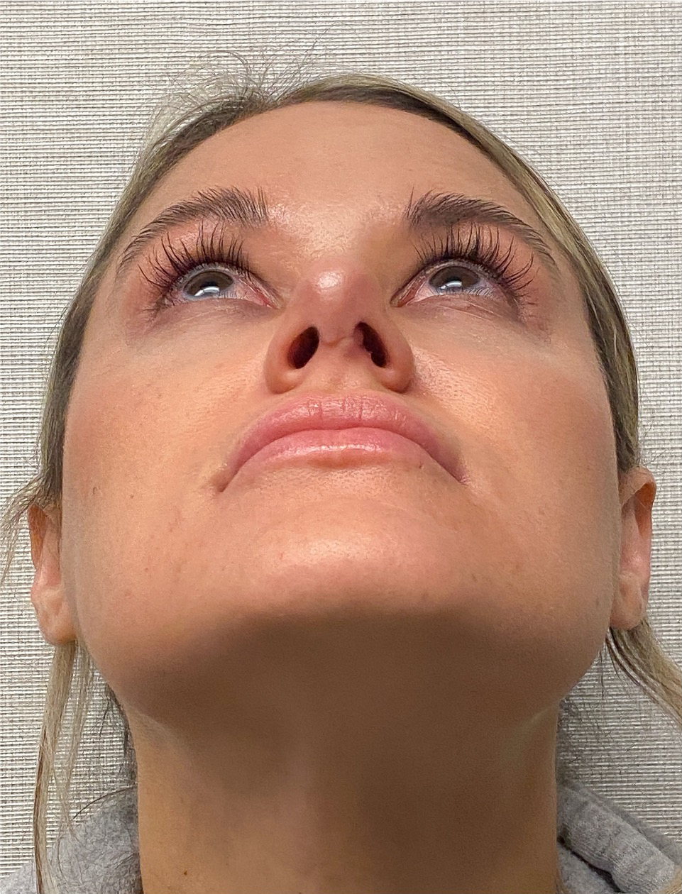 Rhinoplasty-Case--4972 | After Rhinoplasty 2