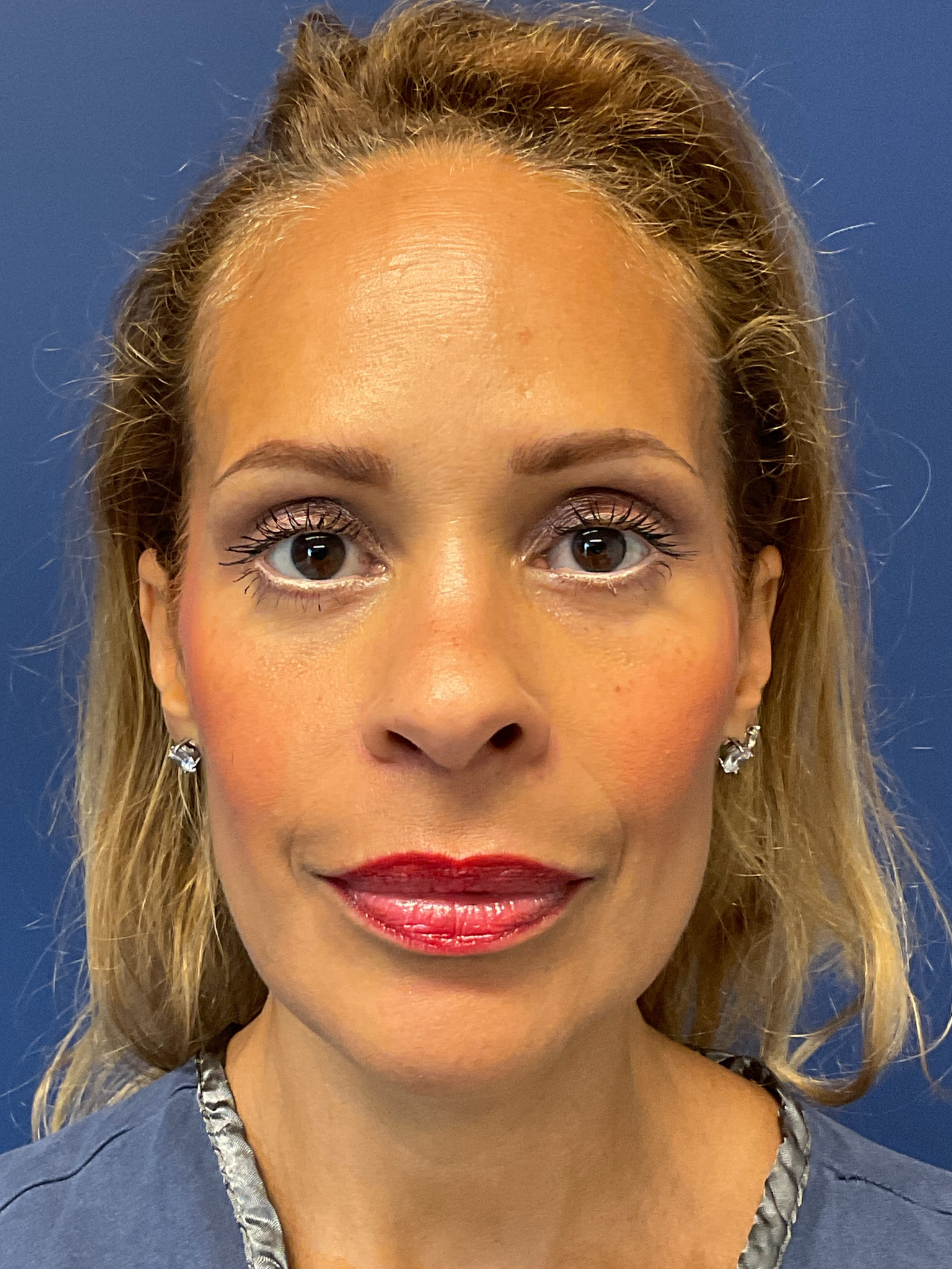 Facelift-and-Facial-Fat-Grafting-Case--4152 | After Facelift 1