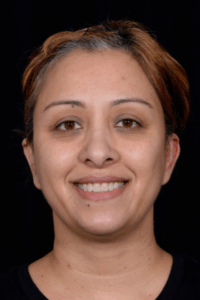 Otoplasty-Case--4655 | After Dr. Arjun Kanuri 1