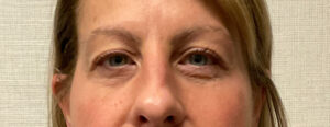 Upper-Blepharoplasty-Case--7202 | After Dr. Arjun Kanuri 1
