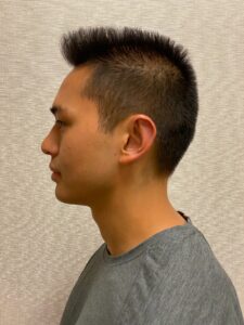 Otoplasty-Case--2681 | After Dr. Arjun Kanuri 2