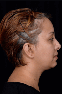 Otoplasty-Case--4655 | After Dr. Arjun Kanuri 2