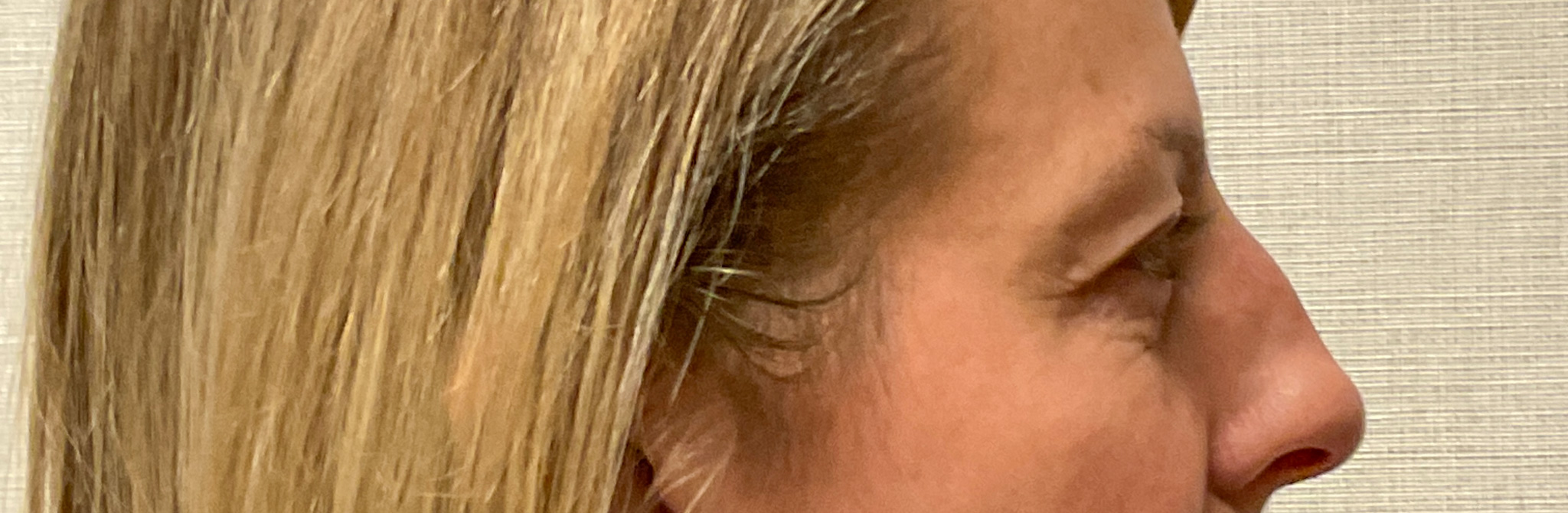 Upper-Blepharoplasty-Case--7202 | Before Eyelid Surgery 4