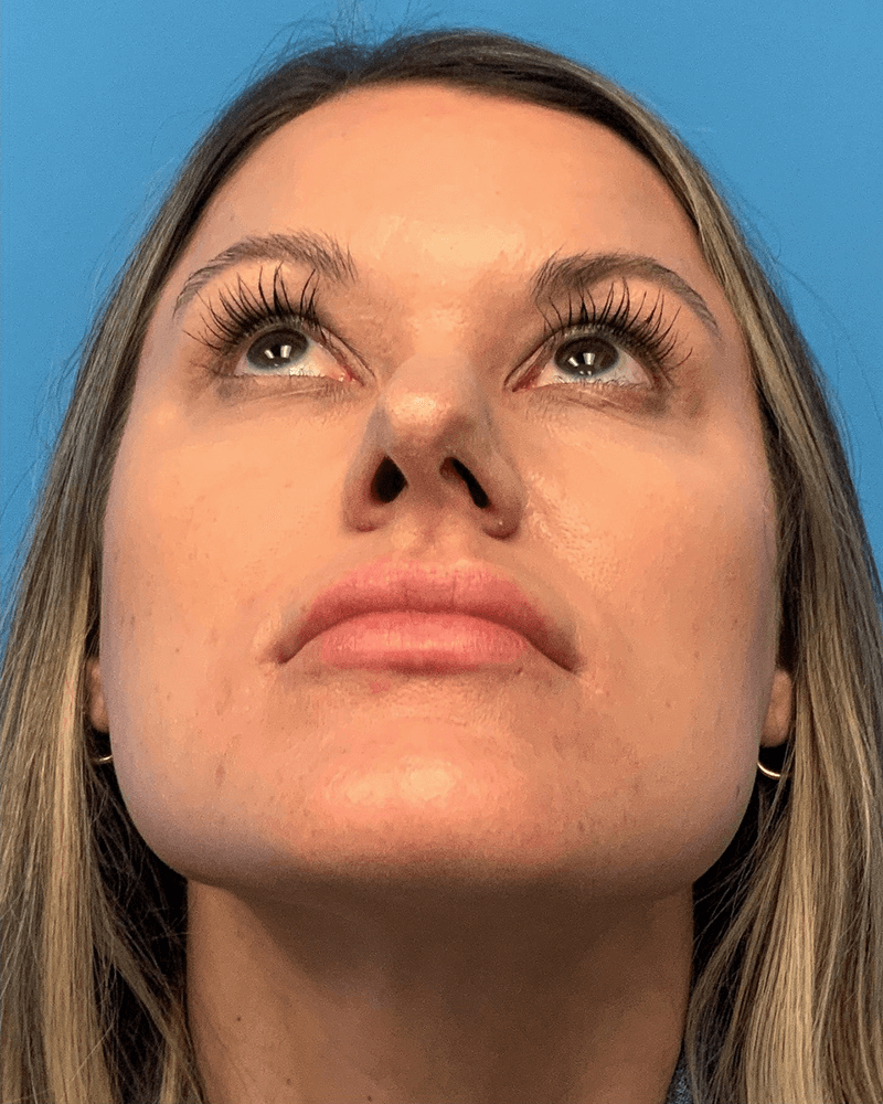 Rhinoplasty-Case--23703 | Before Rhinoplasty 2