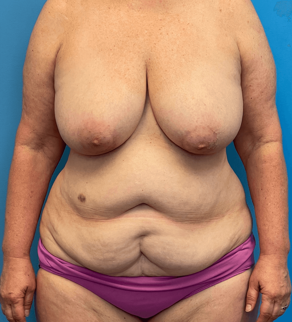Mommy-Makeover-Case--27387 | Before Mommy Makeover 1