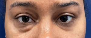 Lower-Blepharoplasty-Case--28049 | Before Eyelid Surgery 1