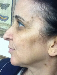 Chemical-Peel-Case--36 | Before CPS Plastic Surgeons 2
