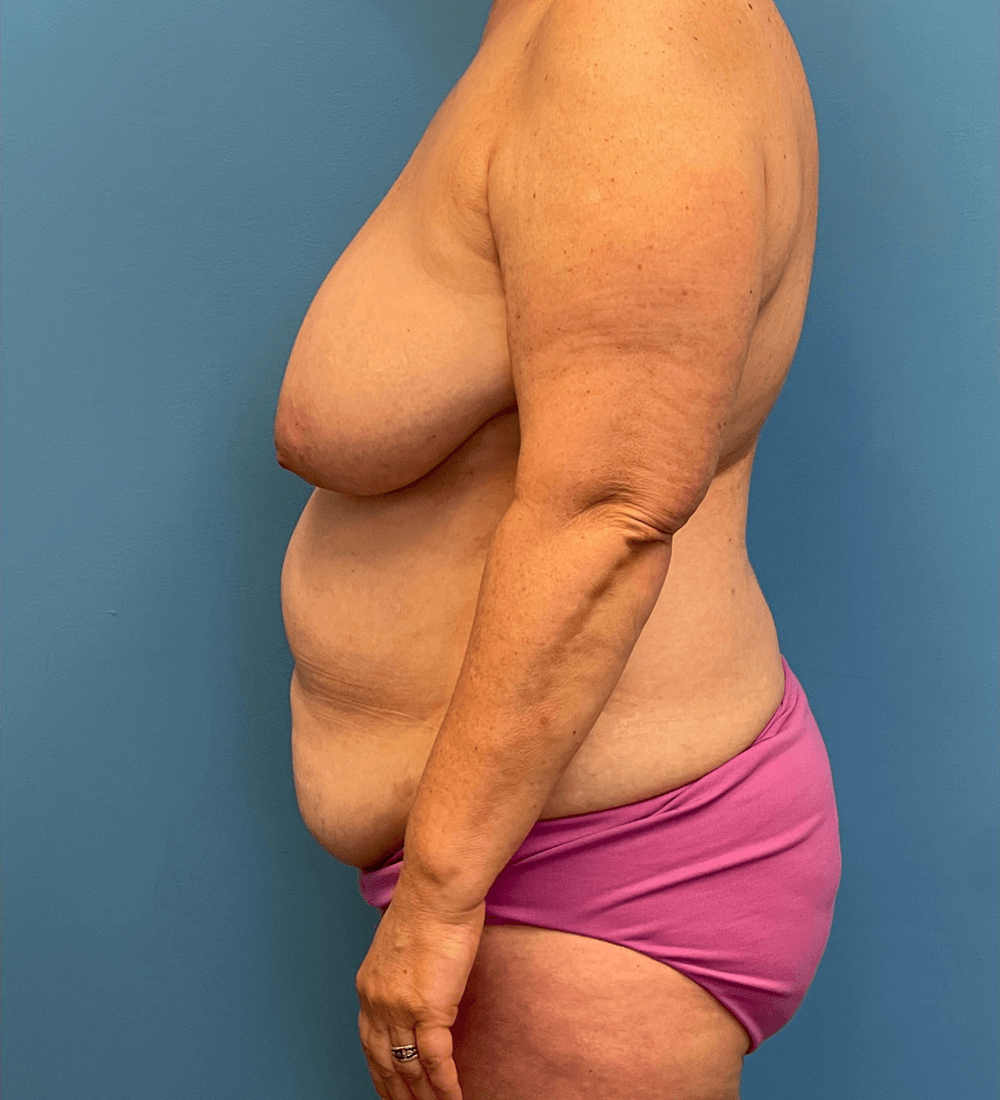 Mommy-Makeover-Case--27387 | Before Mommy Makeover 2