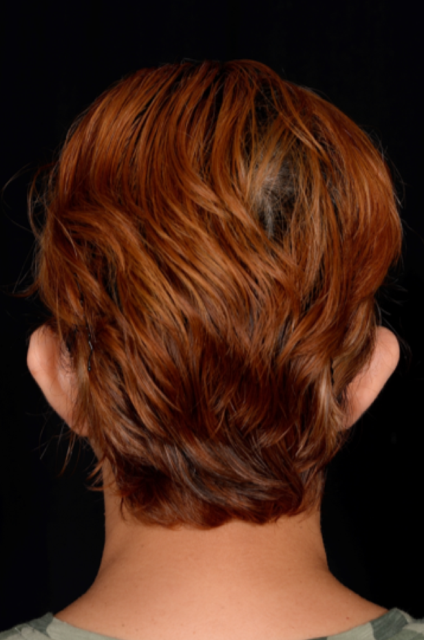 Otoplasty-Case--4655 | Before Otoplasty 5