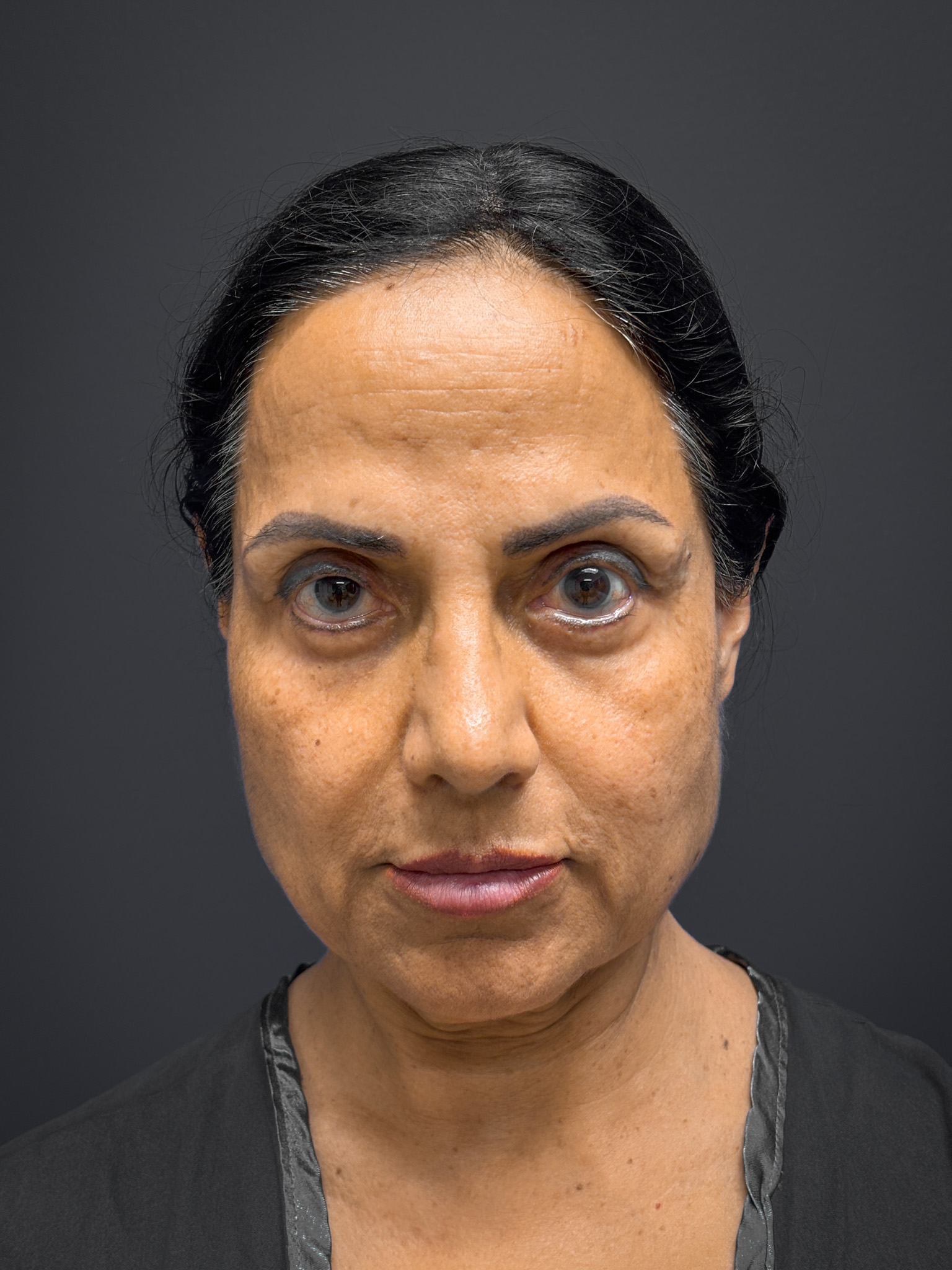 Facelift-and-Facial-Fat-Grafting-Case--8416 | Before Facelift 1