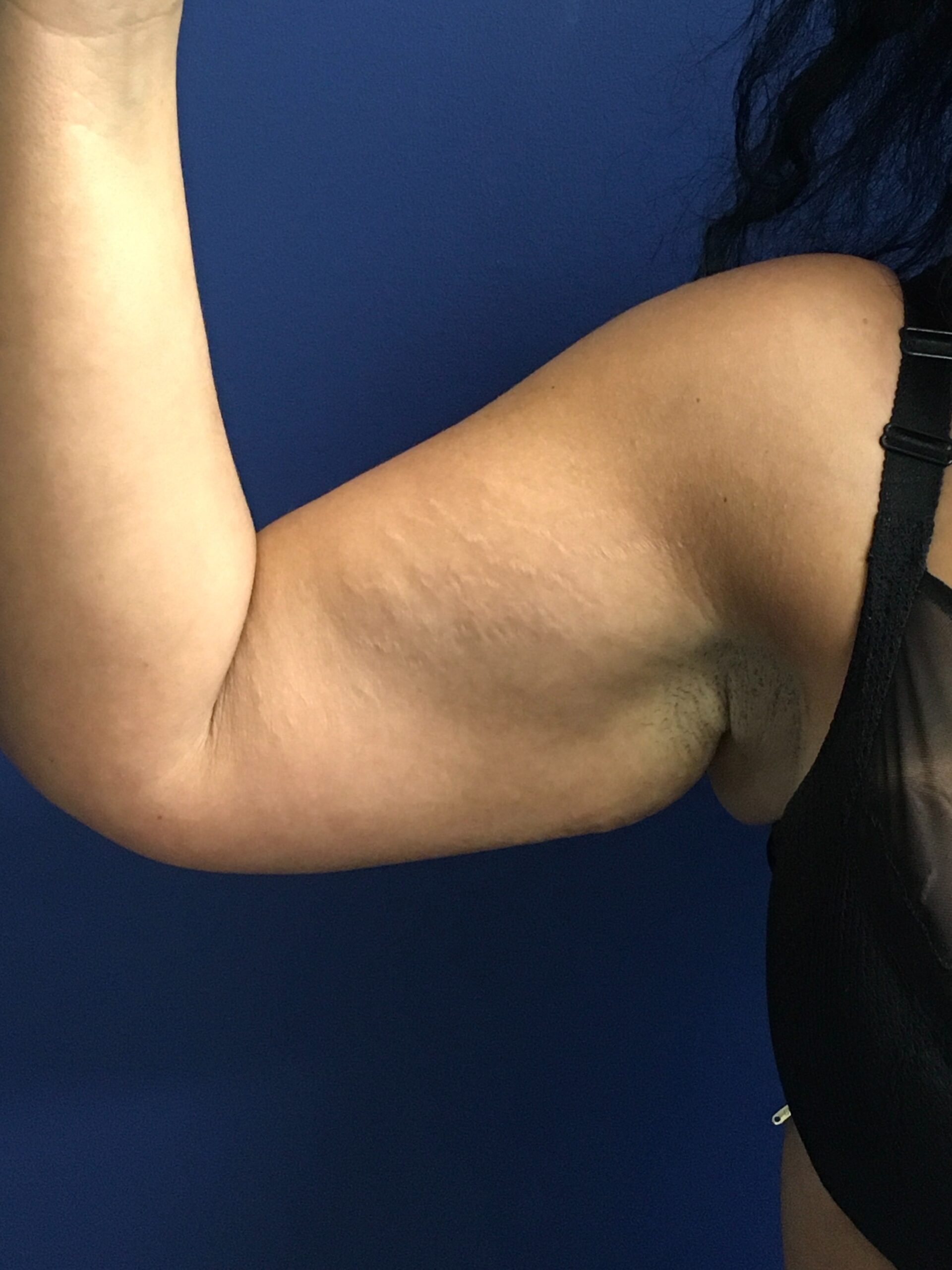 Brachioplasty-Case--1162 | Before Arm Lift 4
