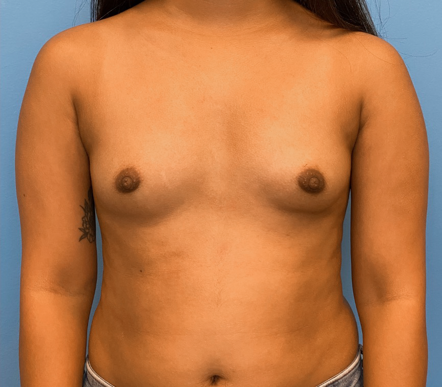 Breast-Augmentation-Case--1115 | Before Breast Augmentation 1