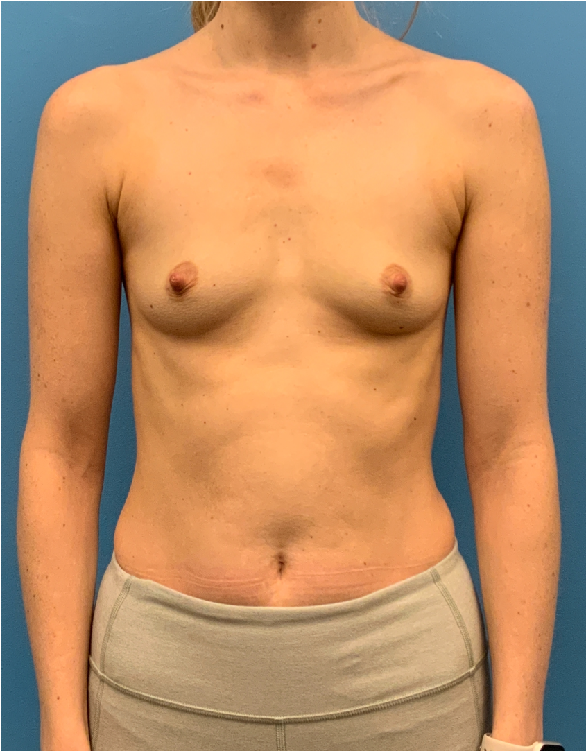 Breast-Augmentation-Case--5309 | Before Breast Augmentation 1