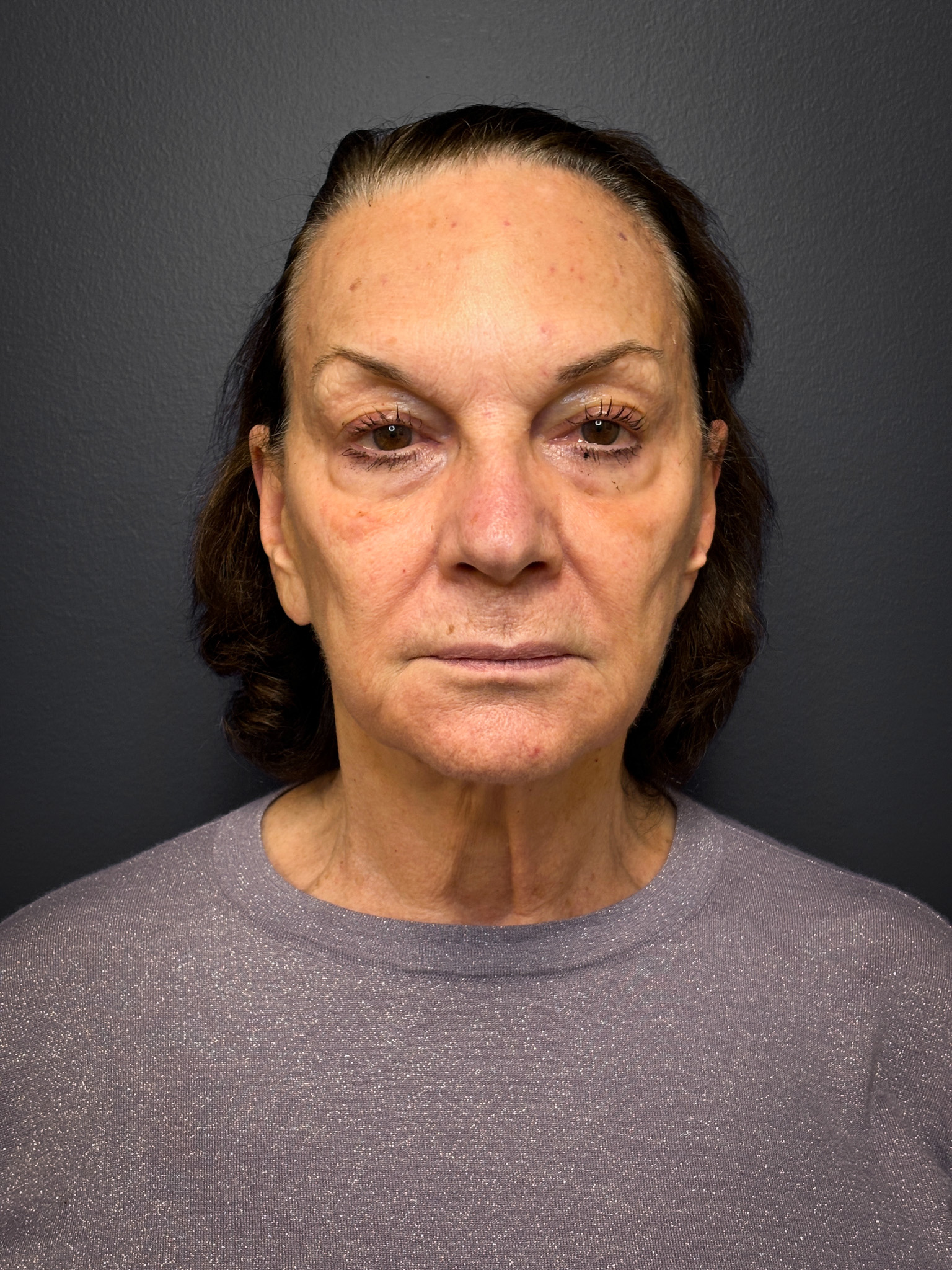 Revision-Facelift-Case--3082 | Before Facelift 1