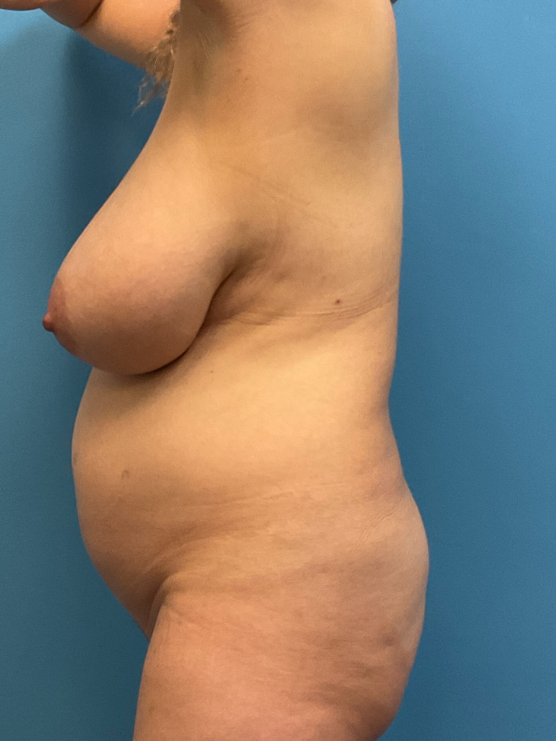 Breast-Reduction-Case--2878 | Before Breast Reduction 2