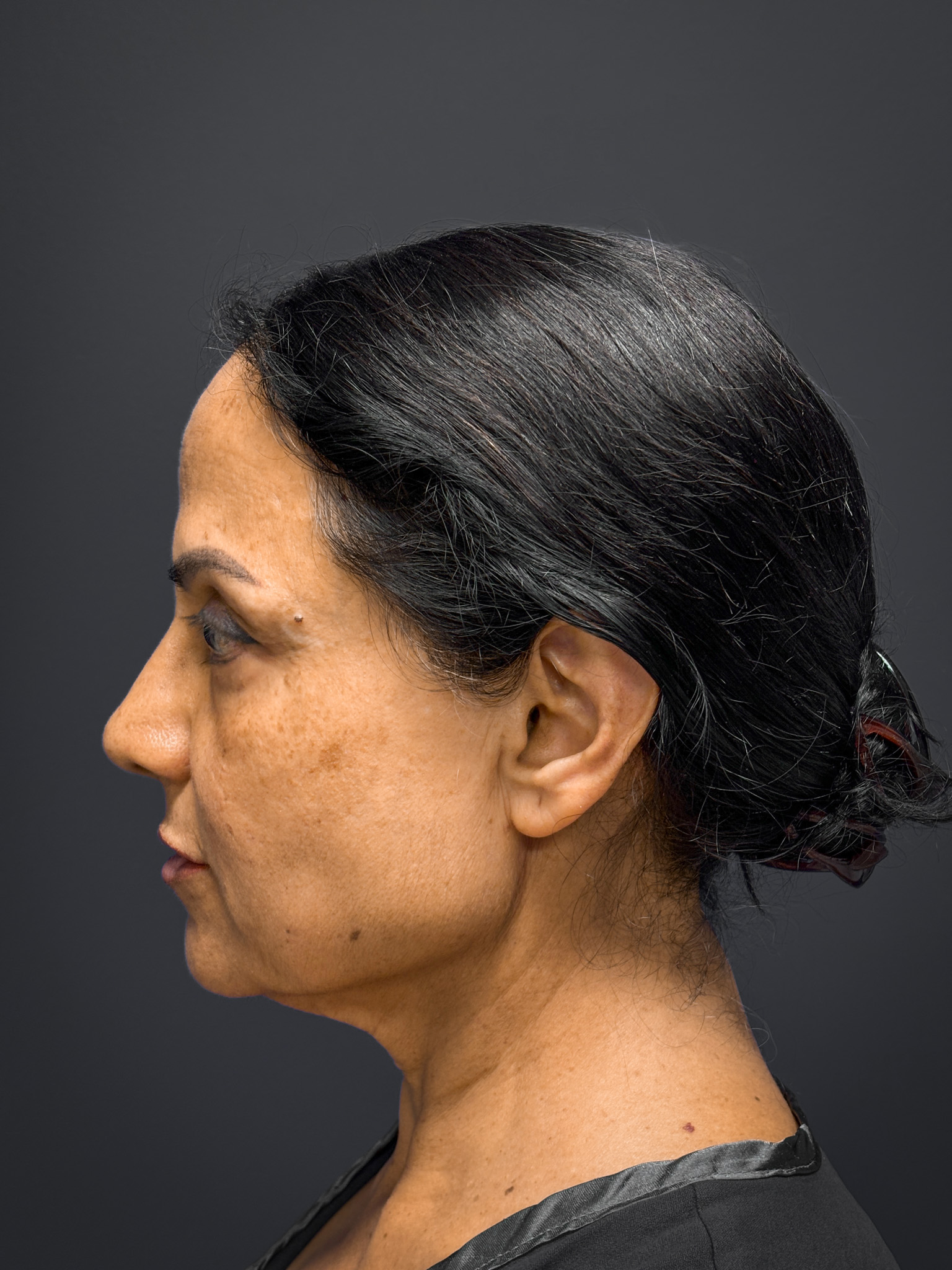 Facelift-and-Facial-Fat-Grafting-Case--8416 | Before Facelift 3