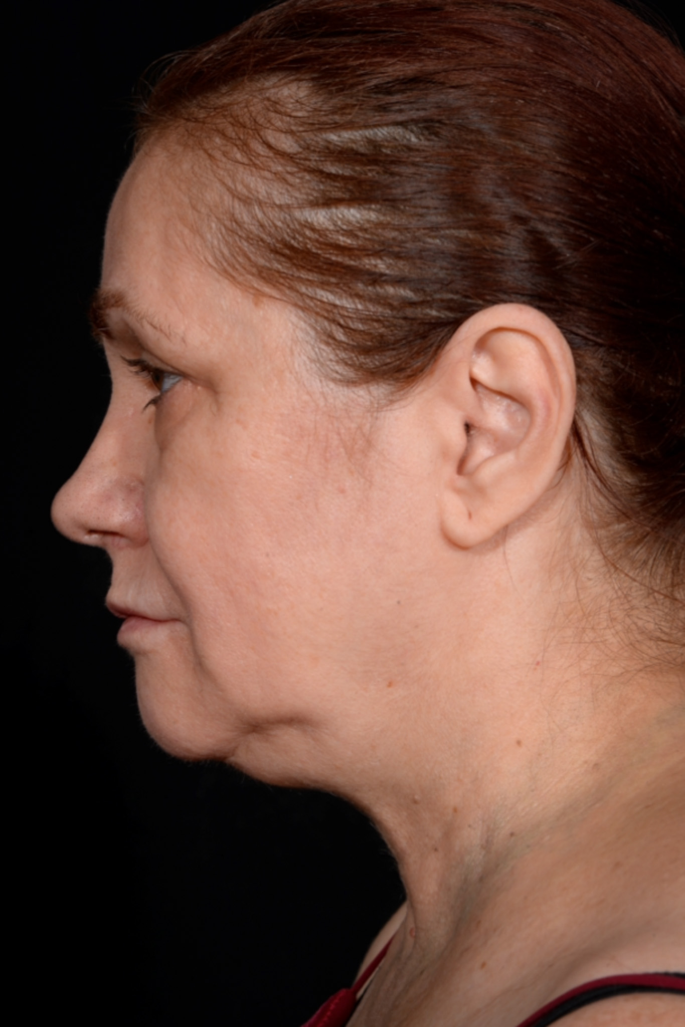 Necklift-Case--1496 | Before Neck Lift 1
