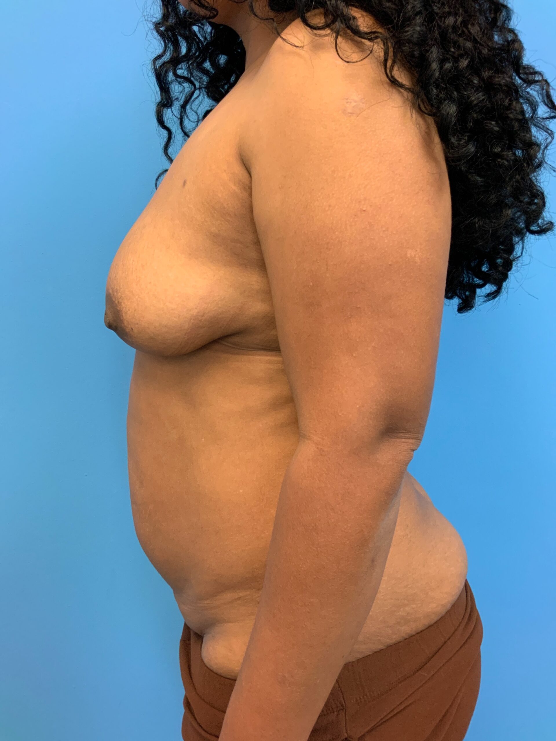 Abdominoplasty-Case--1110 | Before Tummy Tuck 3