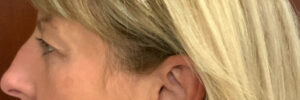 Upper-Blepharoplasty-Case--7202 | After Dr. Arjun Kanuri 2