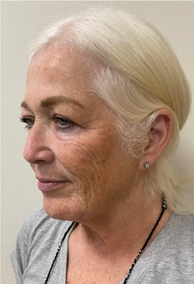 Face-and-Neck-Case--1975 | Before Facelift 3