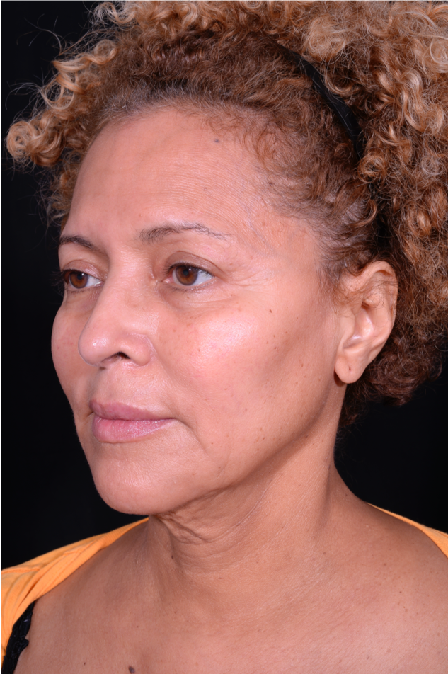 Face-and-Neck-Lift-Case--3772 | Before Facelift 4