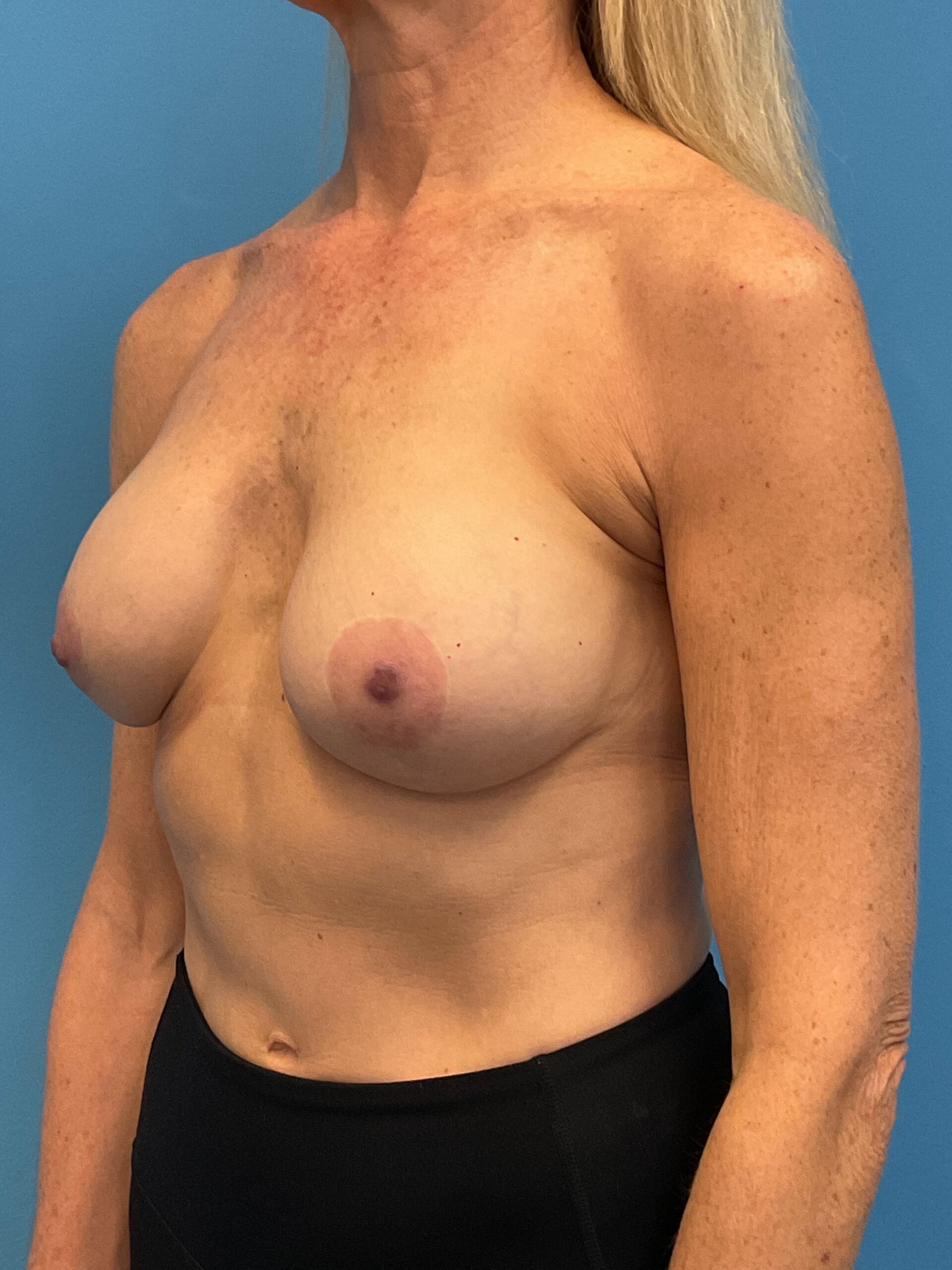 Augmentation-Mastopexy-Case--1505 | Before Breast Augmentation With Lift 5