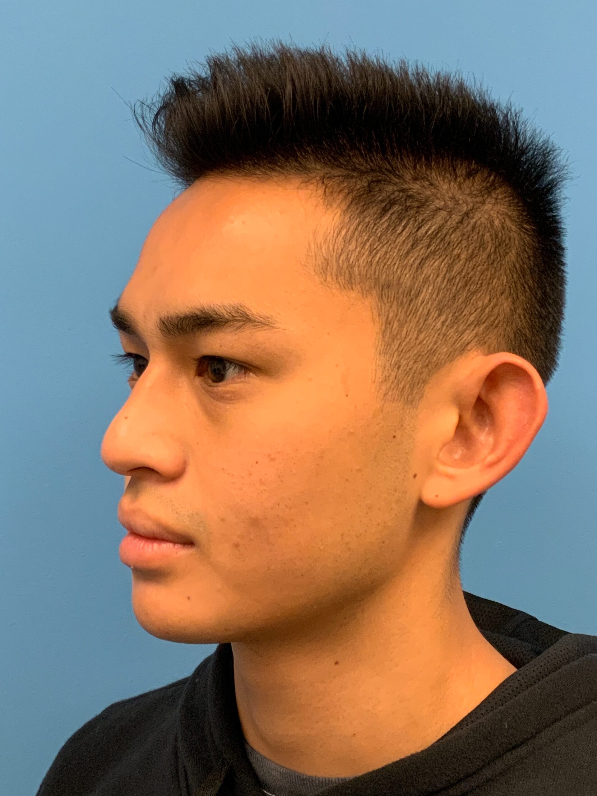 Otoplasty-Case--2681 | Before Otoplasty 4