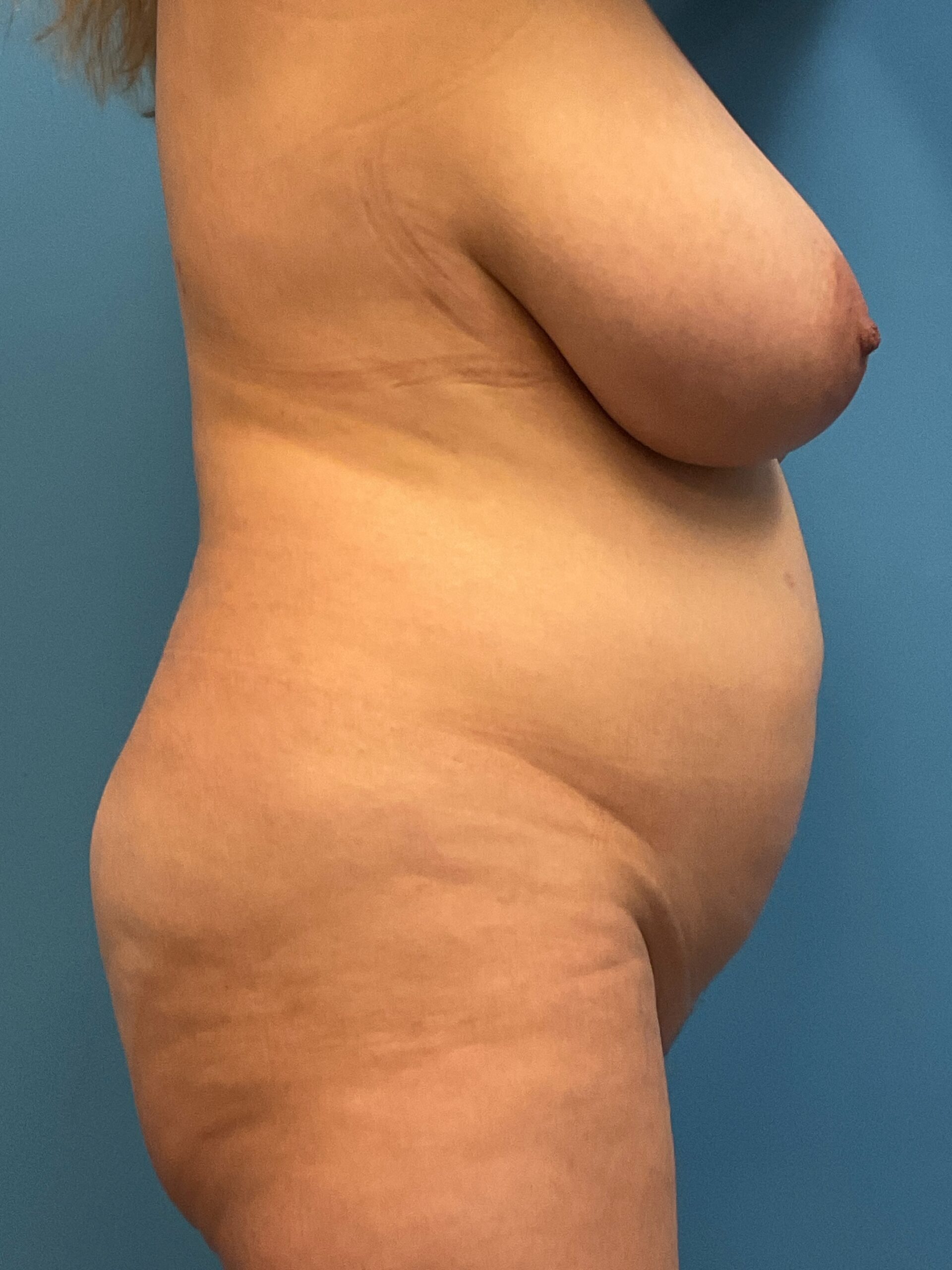 Breast-Reduction-Case--2878 | Before Breast Reduction 3