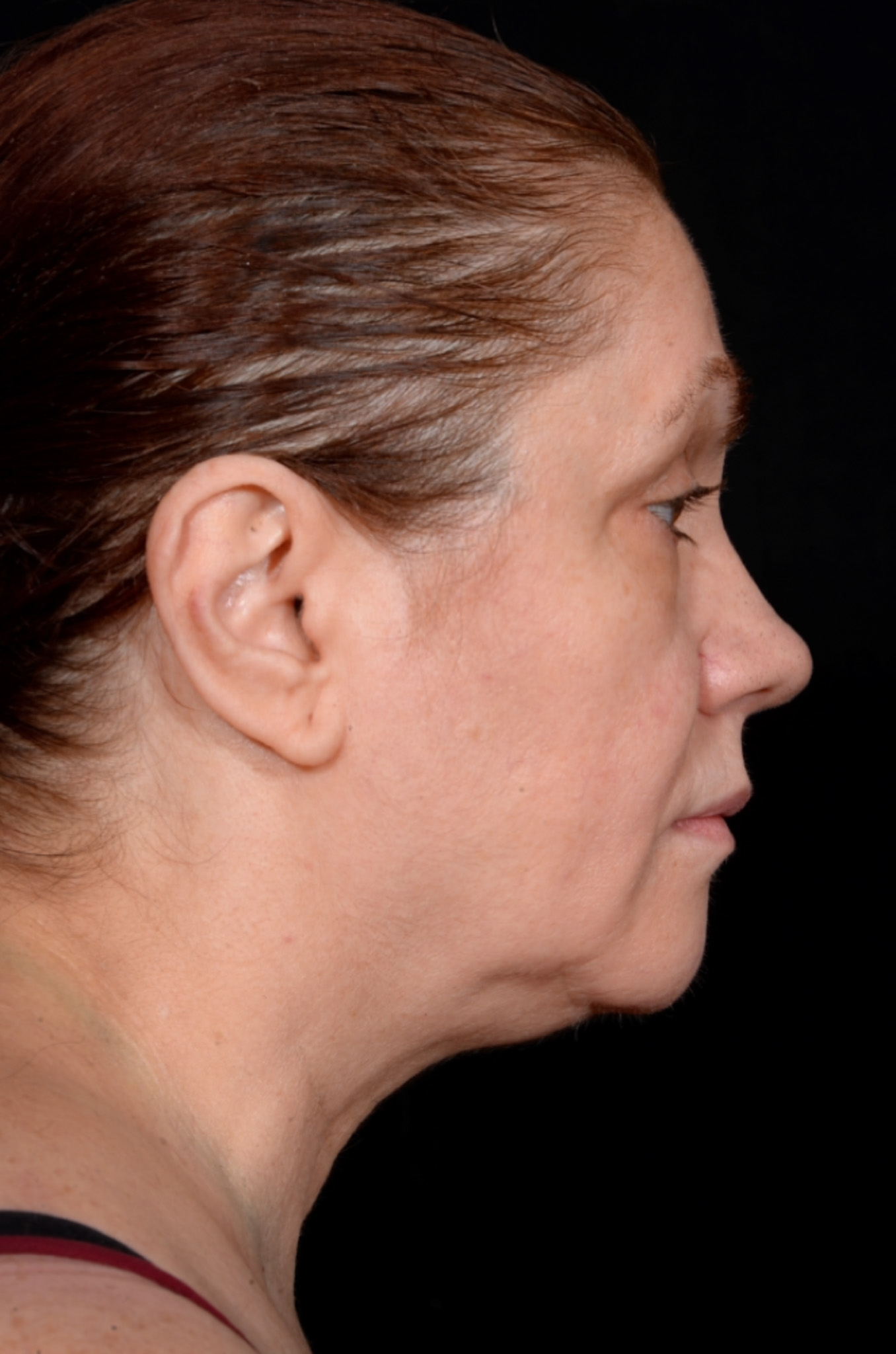 Necklift-Case--1496 | Before Neck Lift 2