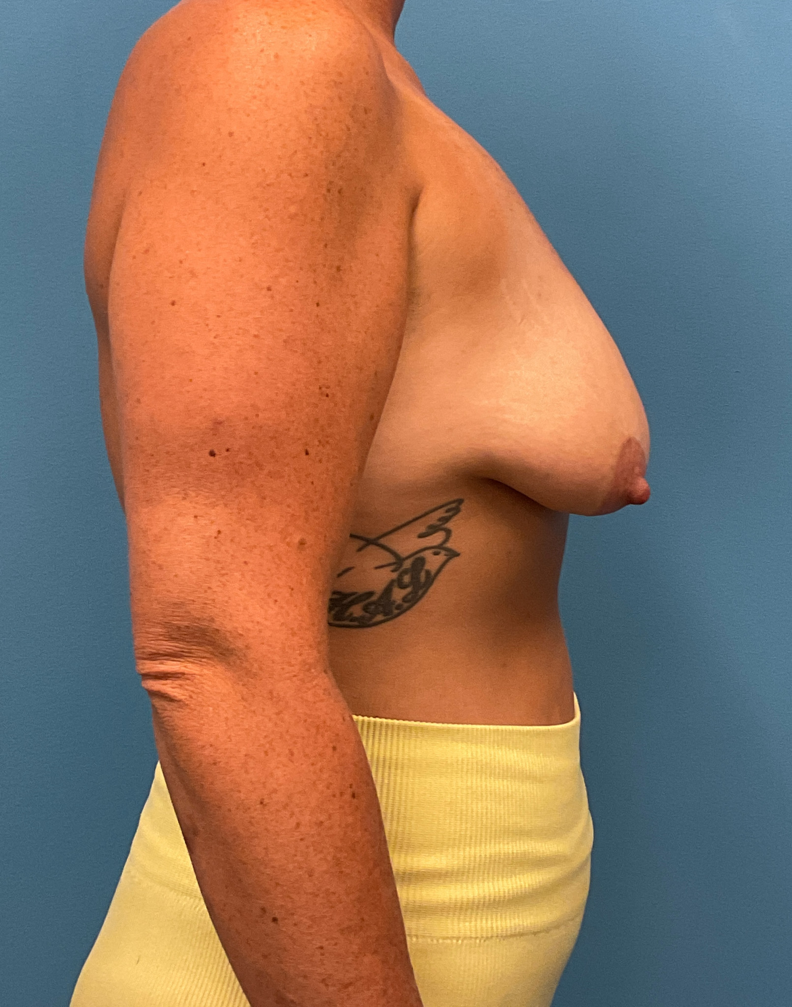 Augmentation-Mastopexy-Case--6355 | Before Breast Augmentation With Lift 2