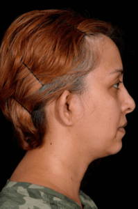 Otoplasty-Case--4655 | Before Dr. Arjun Kanuri 2