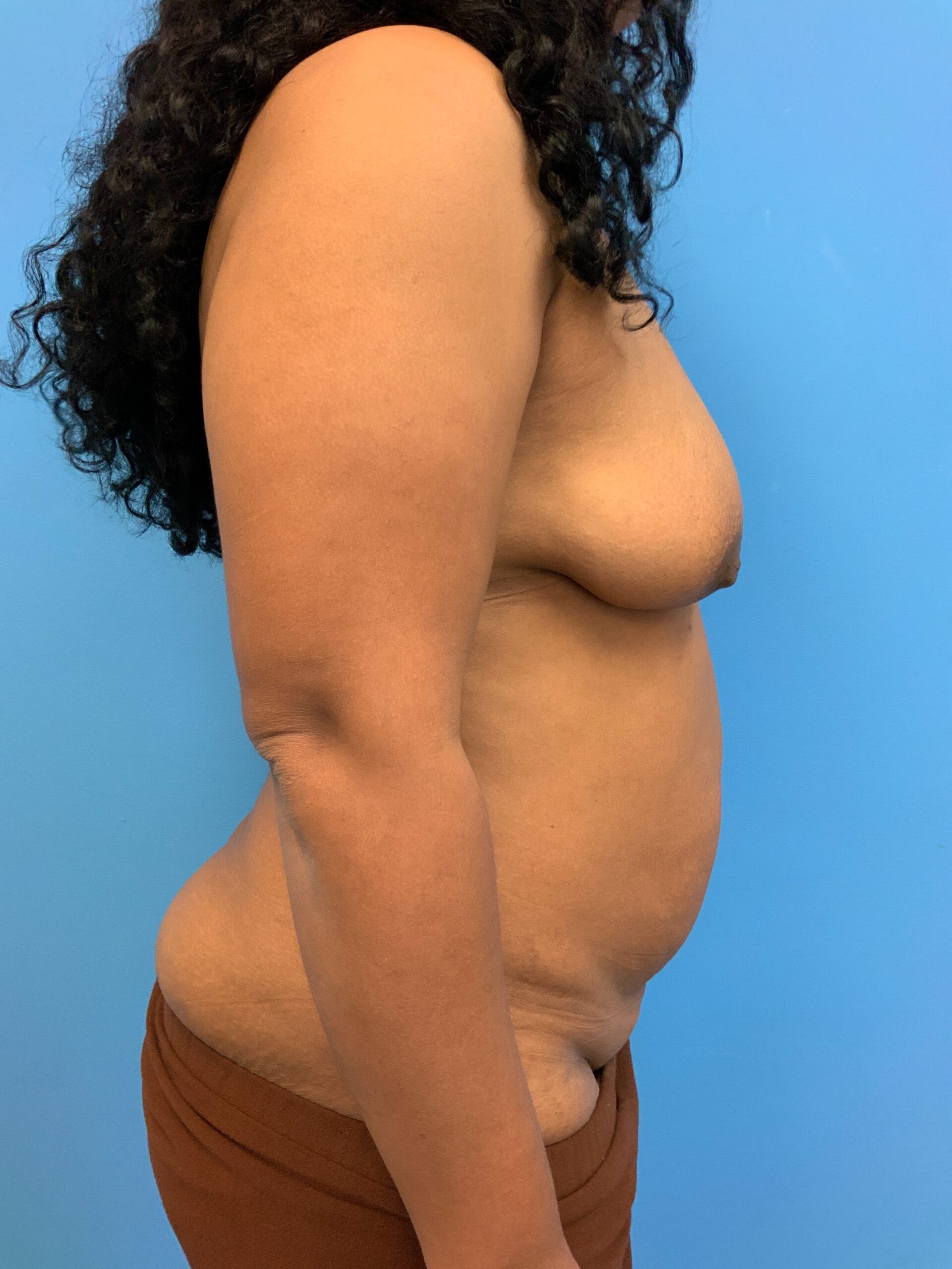 Abdominoplasty-Case--1110 | Before Tummy Tuck 2