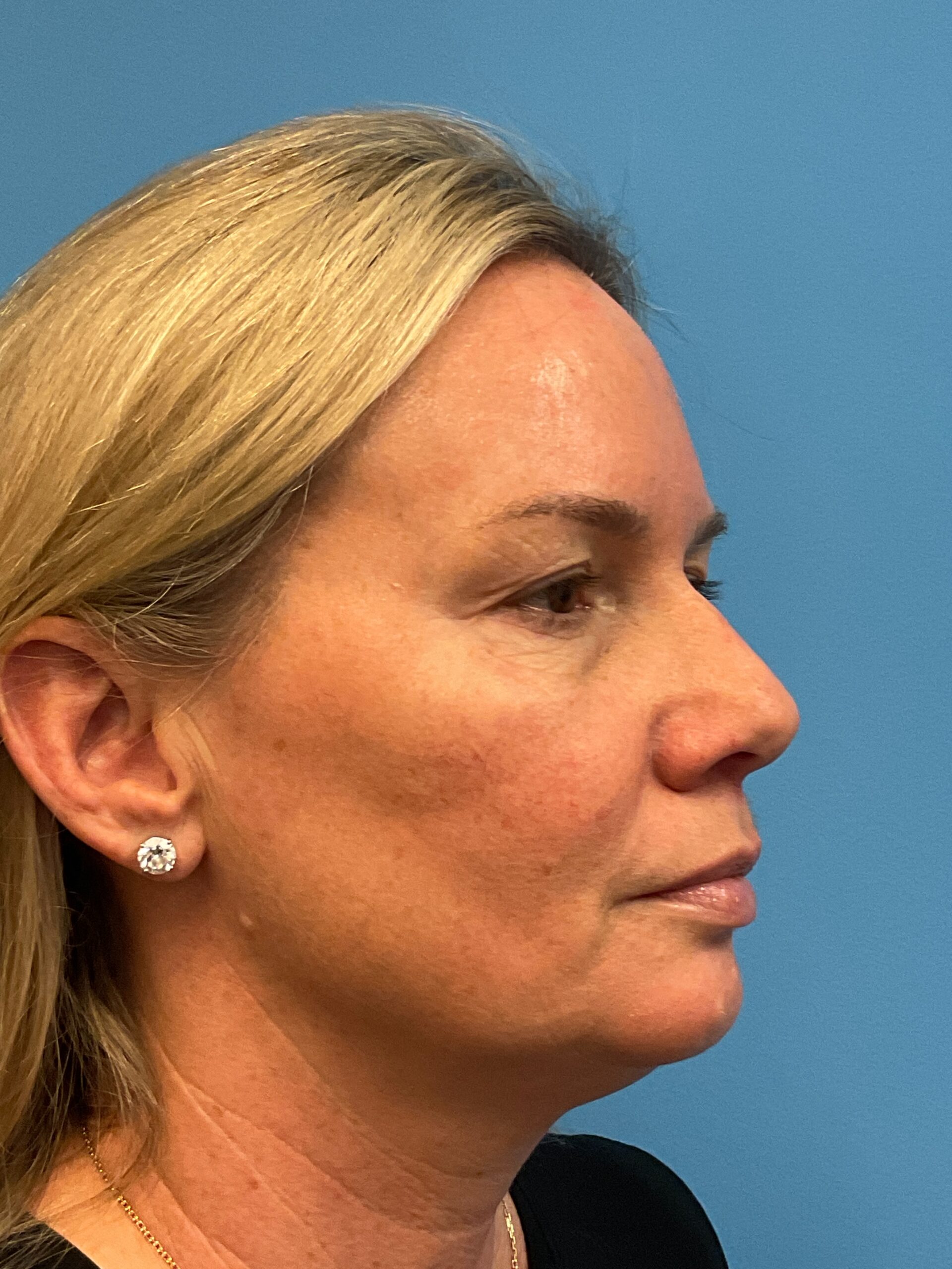 Quad-Blepharoplasty-Case--4265 | Before Eyelid Surgery 3