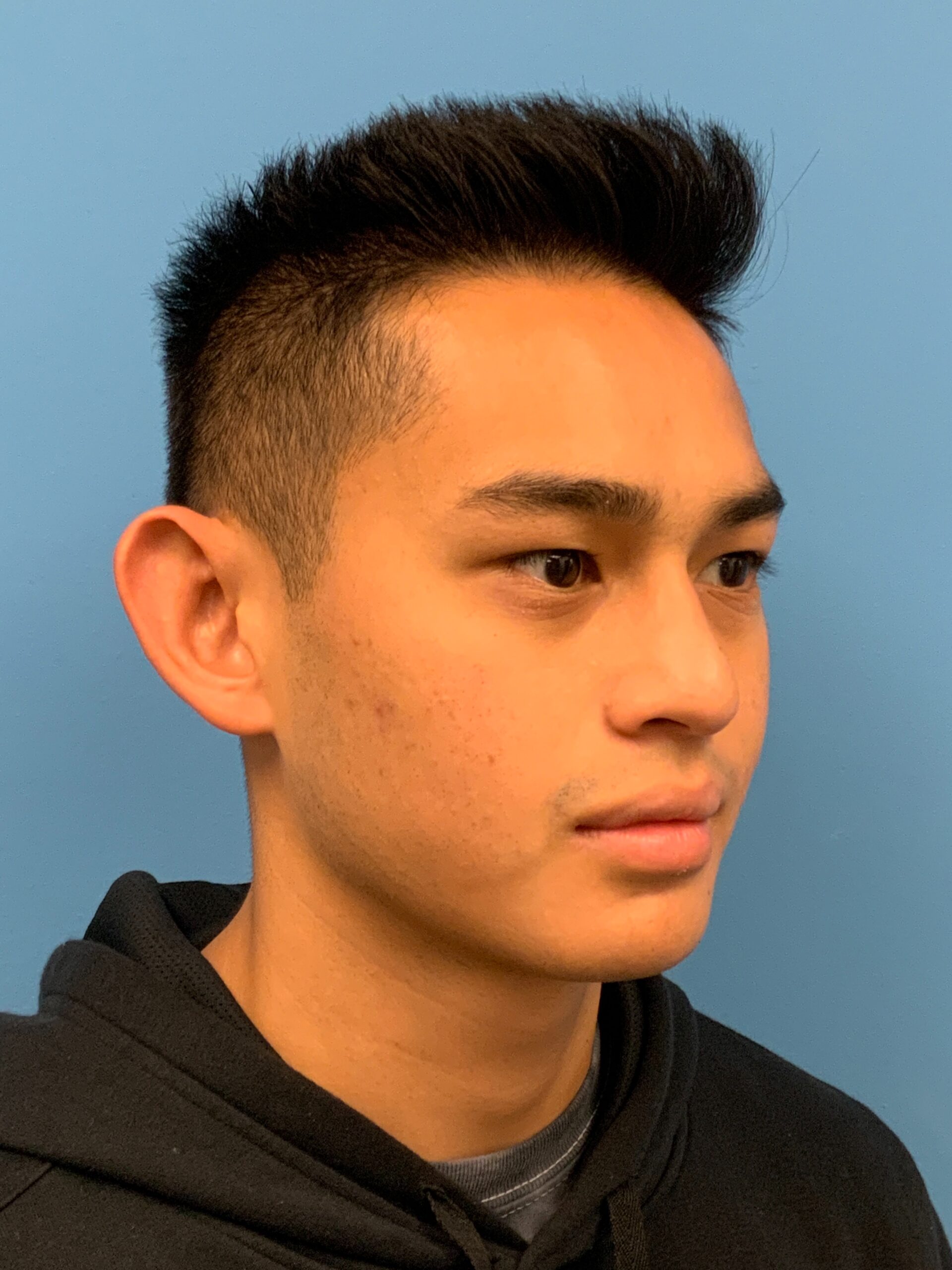 Otoplasty-Case--2681 | Before Otoplasty 5