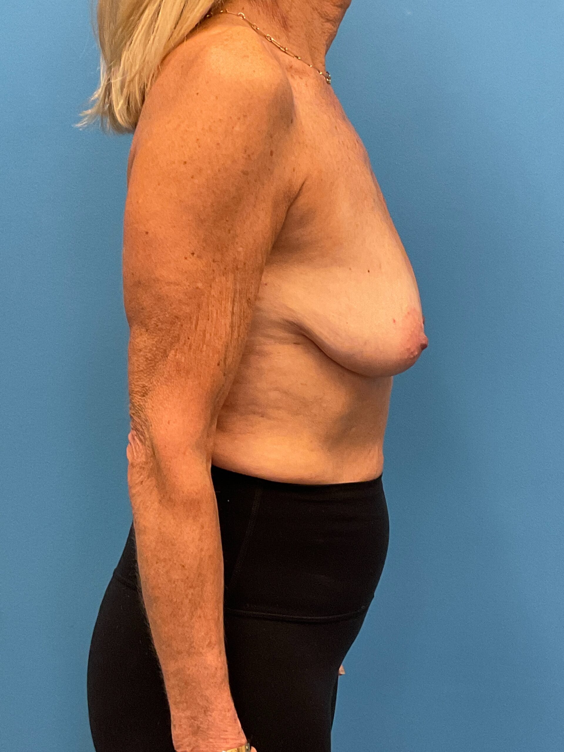 Mastopexy-Case--9216 | Before Breast Lift 3