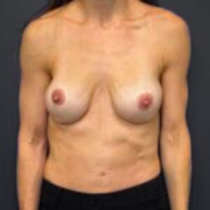 Before Breast Reconstruction (Front Profile)