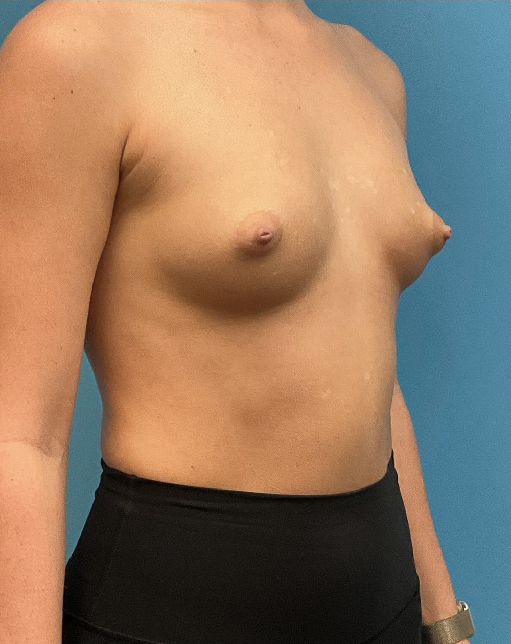 Breast-Augmentation-Case--28179 | Before Breast Augmentation 4
