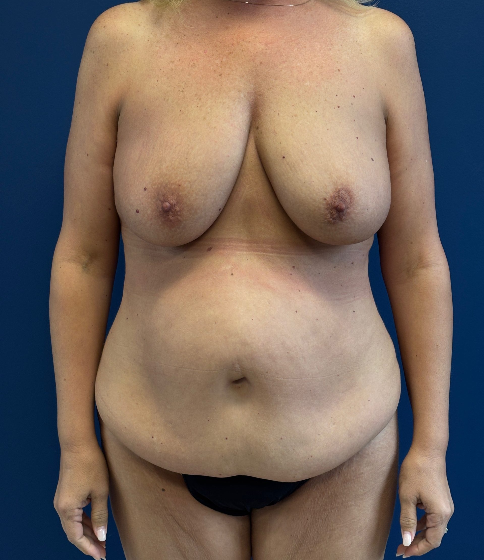 Abdominoplasty-Case--6263 | Before Tummy Tuck 1