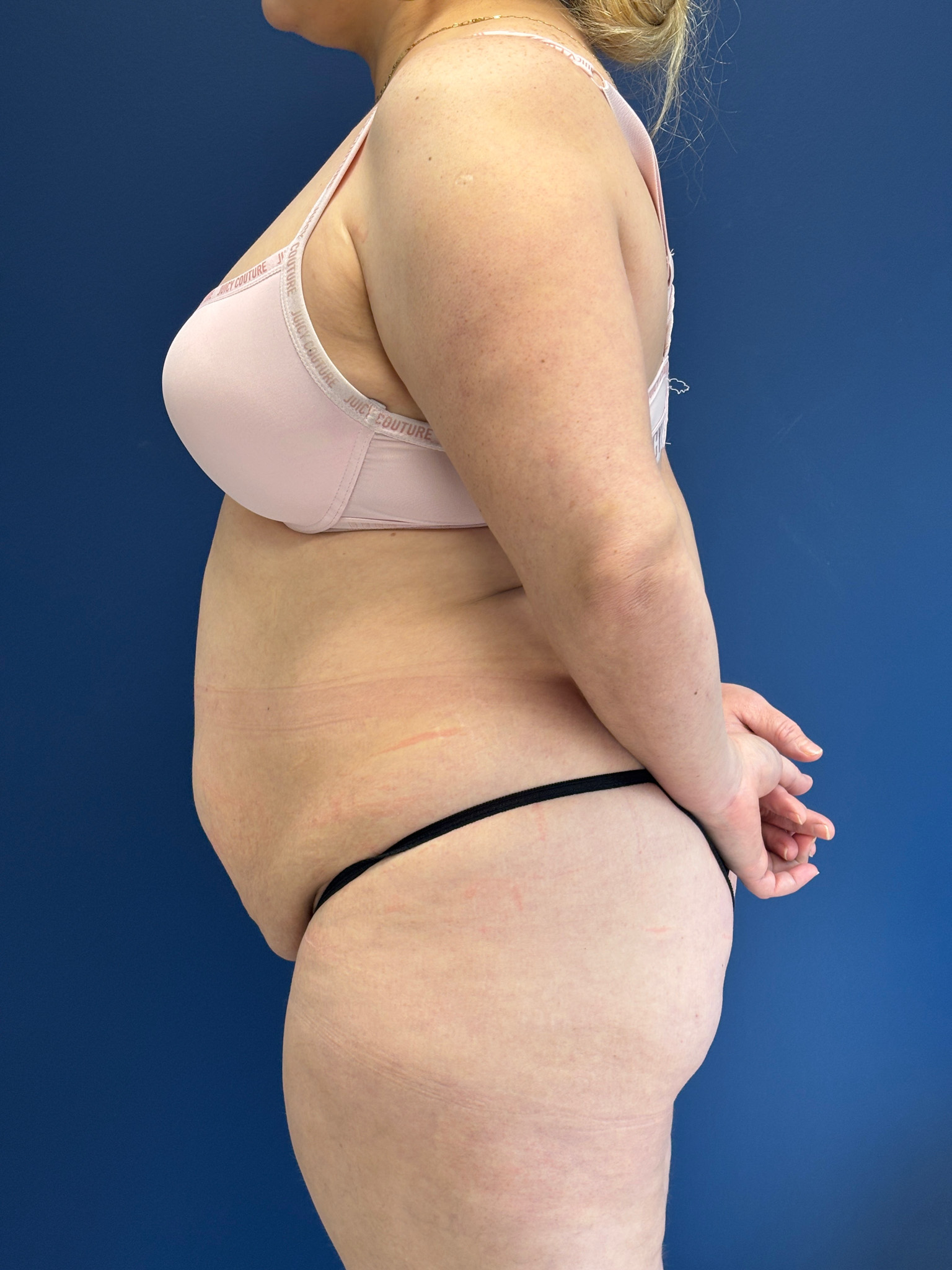 Abdominoplasty-Case--1259 | Before Tummy Tuck 3