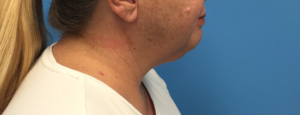Case--391 | After Submental Liposuction 1