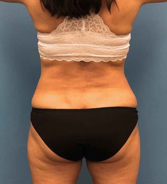 Case--14819 | After Liposuction 4