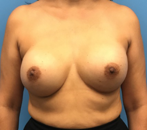 Case--134 | After Dr. Samir Rao 1