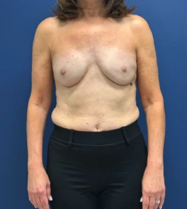 Breast-Reconstruction-Case--28688 | After Breast Reconstruction 1