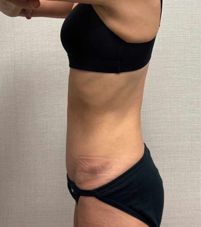 Revision-Tummy-Tuck-Case--23643 | After Tummy Tuck 3