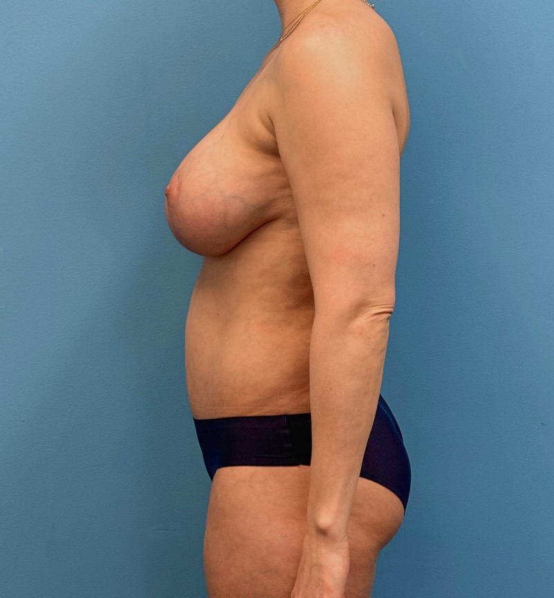 Breast-Augmentation-Tummy-Tuck-Case--28080 | After Body Lift 6