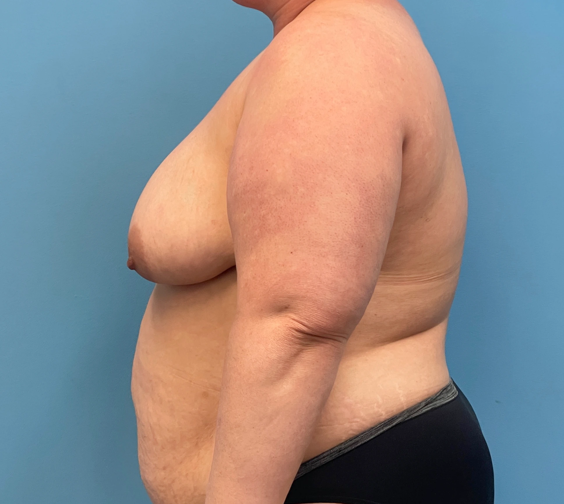 DIEP-Flap-Case--27595 | Before DIEP Flap 2