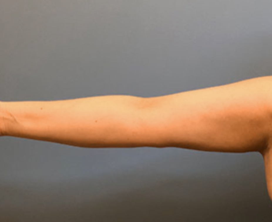 Brachioplasty-Case--78 | After Arm Lift 1