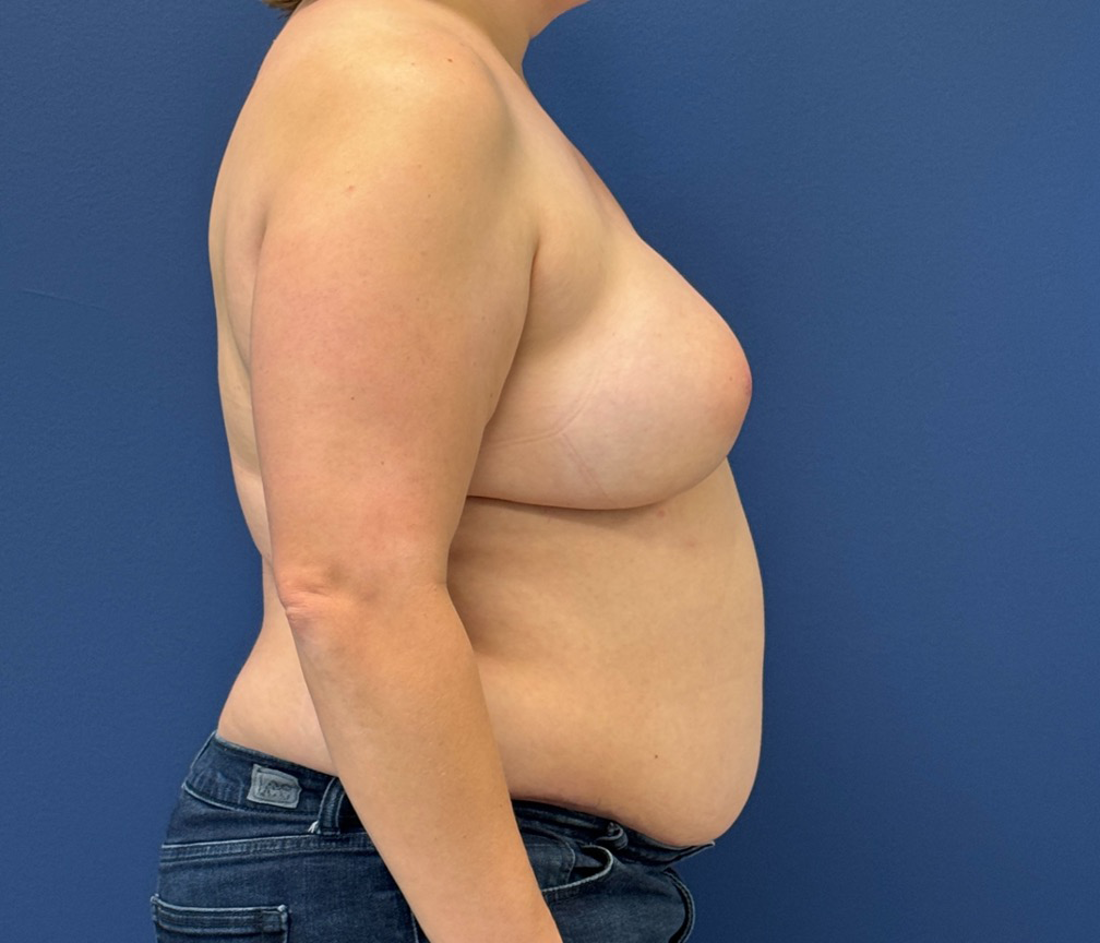 DIEP-Flap-Case--28021 | After DIEP Flap 3